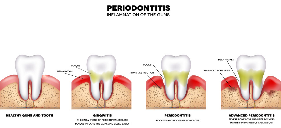 The Stages of Periodontitis