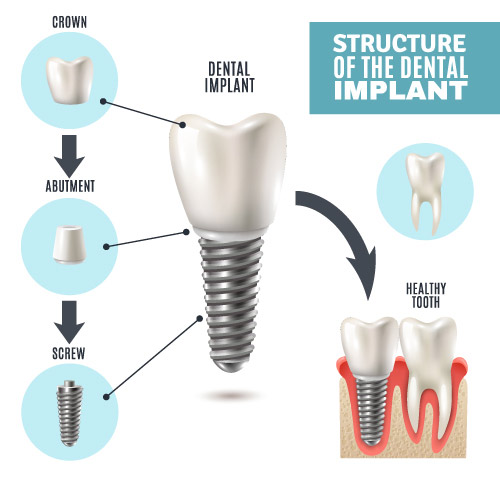 Structure of a Dental Implant